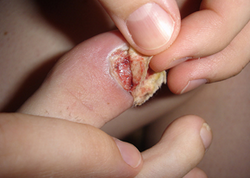 Рубромікоз нігтів фото, причини, лікування, грибкові захворювання