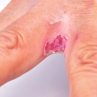 Рубромікоз нігтів фото, причини, лікування, грибкові захворювання