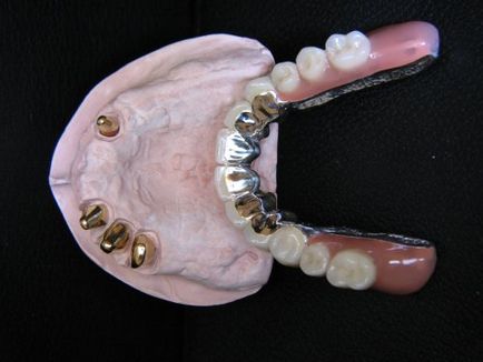 Protetică detașabilă a dinților și indicații
