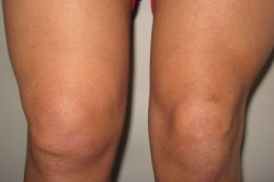 Synovita simptomelor articulației genunchiului și tratamentului la remediile populare la domiciliu, medicamente, LUTS