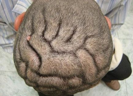 Pachydermia pliată a tratamentului pielii scalpului - o clinică pentru tratamentul părului de la Moscova