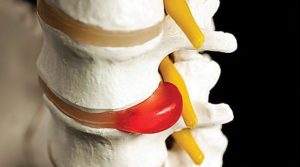 Afecțiuni vasculare ale leziunilor măduvei spinării din coarnele anterioare, inflamații, simptome de înfrângere