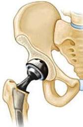 Modern endoprosthesis de șold