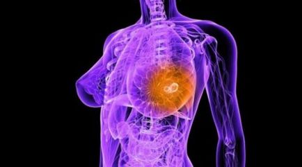 Etapele clasificării și principiilor tratamentului cancerului mamar