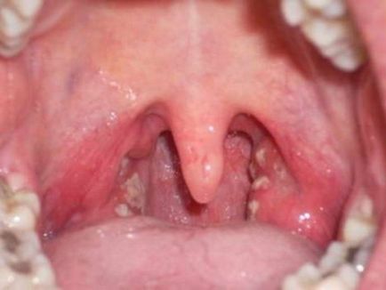 Staphylococcus aureus - simptome la adulți și copii, fotografii în gât și gât