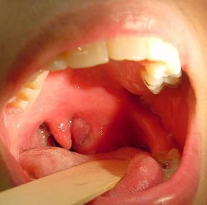 Золотистий стафілокок ауреус - симптоми у дорослого і дитини, фото в горлі і зеве