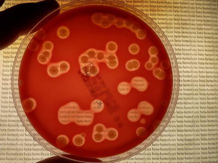 Staphylococcus aureus - simptome la adulți și copii, fotografii în gât și gât