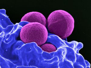 Staphylococcus aureus - simptome la adulți și copii, fotografii în gât și gât