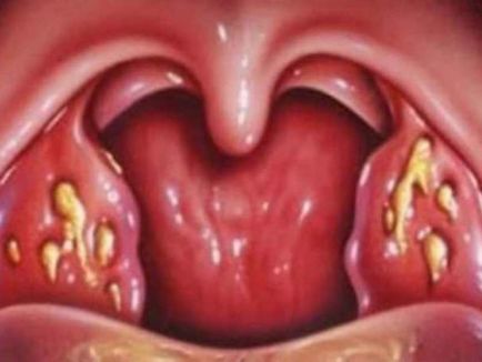 Золотистий стафілокок ауреус - симптоми у дорослого і дитини, фото в горлі і зеве