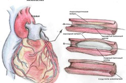 Stentul arterei coronare