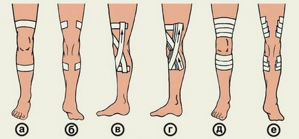 Тейпірованіе колінного суглоба види, переваги, показання та протипоказання