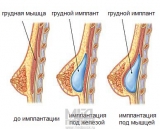 Mărirea sânilor - Implanturi mamare siliconice