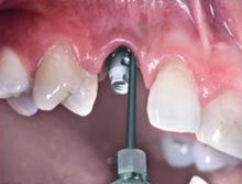 Догляд за імплантами зубів