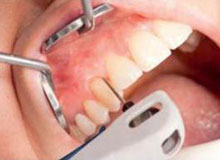 Догляд за імплантами зубів