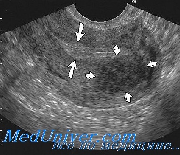 Imaginea Uzi a uterului, trompelor uterine, ovarele normale