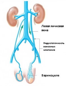 Tratamentul cu Varicocele, cauze, diagnostic