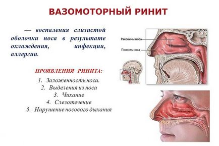 Vazomotoros rhinitis tüneteinek, gyógynövényes kezelés