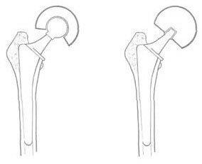 Види ендопротезування кульшового суглоба