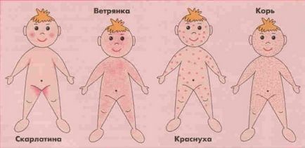 Típusú kiütések a gyerek, mi az a kiütés meghatározás - terhesség, szülési, otthon, család, gyermek, szépség (néhány kiütés gyermekeknél) Típusú kiütések a gyerek, mi az a kiütés meghatározás - terhesség, szülési, otthon, család, gyermek, szépség