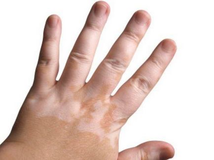 Vitiligo în cauzele copiilor, tratamentul, trăsăturile bolii