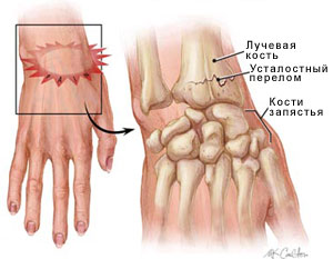 Dislocarea încheieturii mâinii, simptome, semne, diagnostic și tratament