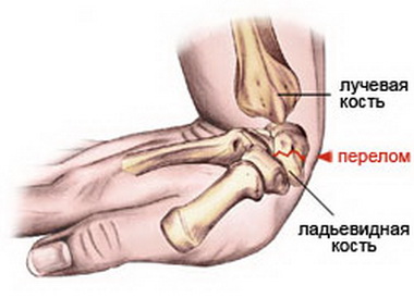 Dislocarea încheieturii mâinii, simptome, semne, diagnostic și tratament