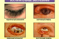 Orz intern pe ochiul cauzei, simptome, tratament