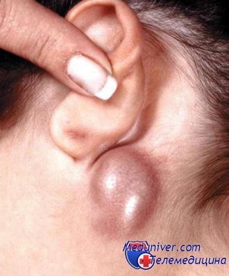 Nodul limfatic inflamat în ureche - gtsf