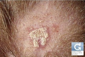 Запальні захворювання шкіри волосистої частини голови (російська мова) - globale dermatologie