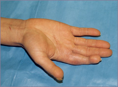 Recuperarea vârfurilor degetului