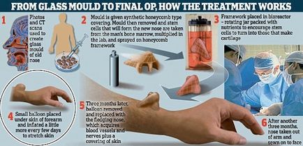 Лікарі виростили англійської бізнесменові ніс на руці - фактрум