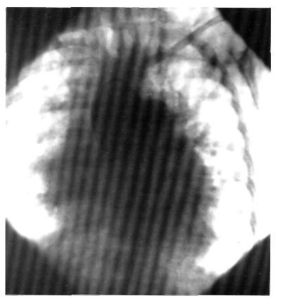 Veleszületett szívhibák septum defektus aortolegochnoy