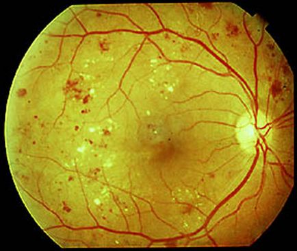 ретината хирургия, очите клиника branchevskogo