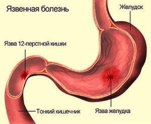 Tratamentul cu medicamente pentru ulcerul duodenal