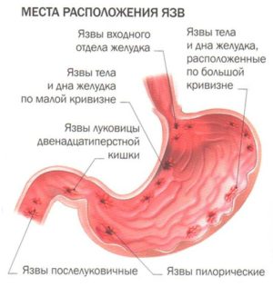 Ulcer de stomac