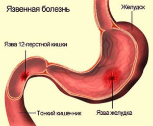 Виразка шлунку