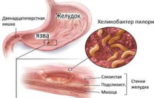 Ulcer de stomac