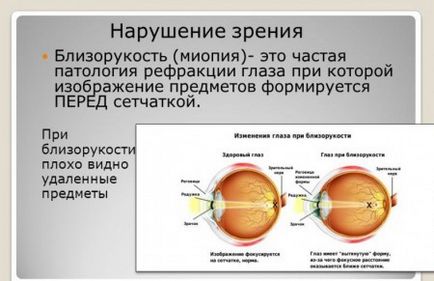 Töltés a szemnek myopia, hogyan kell elvégezni