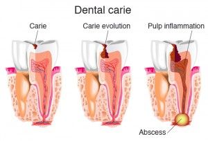 Absența simptomelor purulente ale dinților