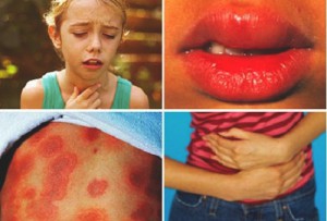 Алергія на виноград у дитини симптоми і лікування