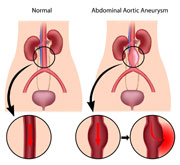 Aruncări arteriovenoase pentru operațiile venelor, centru medical barzilai