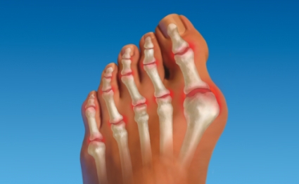 Artrita cauzată de degetele picioarelor, simptome și tratament, leziuni articulare la degetul mare