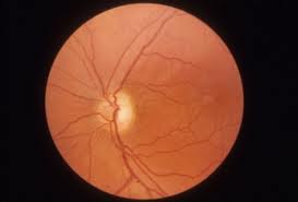 Atrofia simptomelor nervoase optice, cauzele, diagnosticul și tratamentul