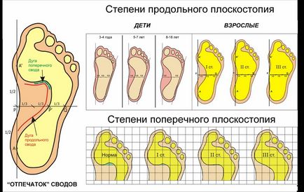 Чи беруть в армію з плоскостопістю, види плоскостопості