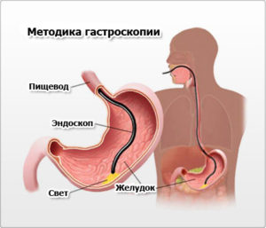 Біопсія шлунка підготовка, відгуки, ціни