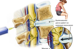 Blocarea coloanei vertebrale cu hernie cauze de hernie și metode de anestezie, contraindicații (video)
