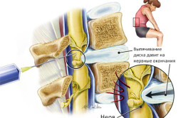 Блокада хребта при грижі причини грижі і способи знеболювання, протипоказання (відео)