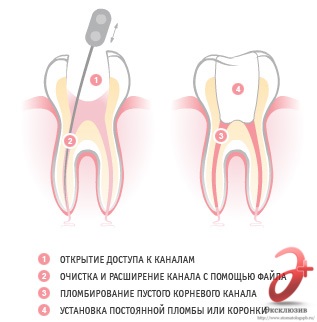 Un dinte fără nervi sau după umplere este dureros - ce trebuie să faceți