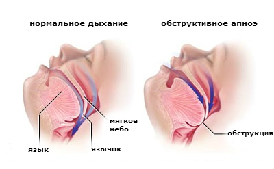 Що являє собою синдром нічного апное