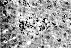 Ciroza hepatică la ultima etapă a simptomelor, tratamentul